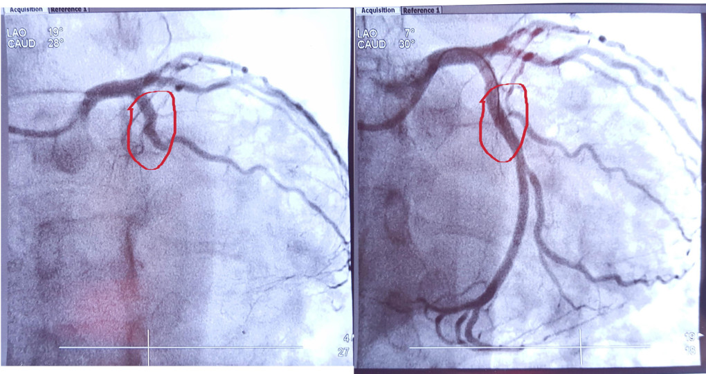 My heart - before the stent