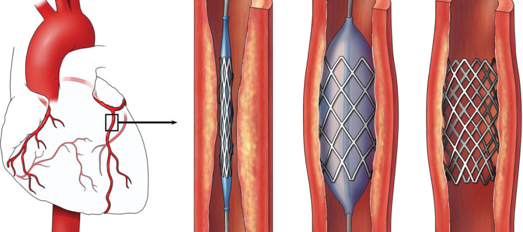 Stent explained